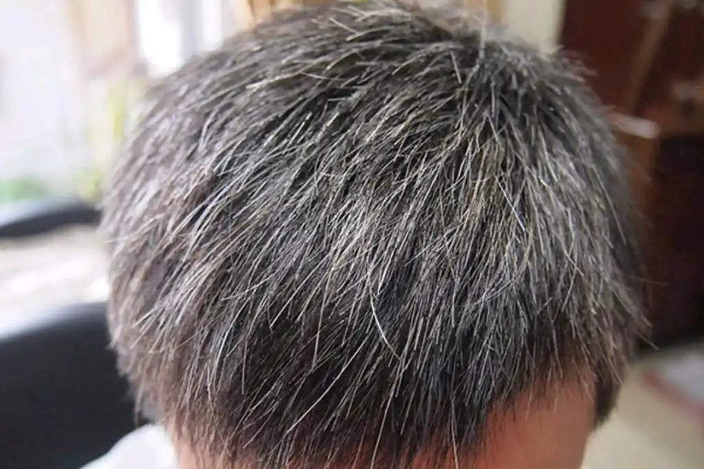 年纪不大却长出了白头发能染吗生活中做到这3件事或可改善