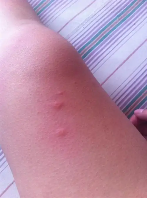 皮肤瘙痒起红疙瘩图片皮肤瘙痒是什么原因用什么药治疗