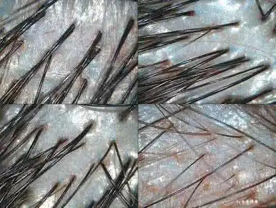 掉发发根有小白点,这小白点是坏死的毛囊吗?