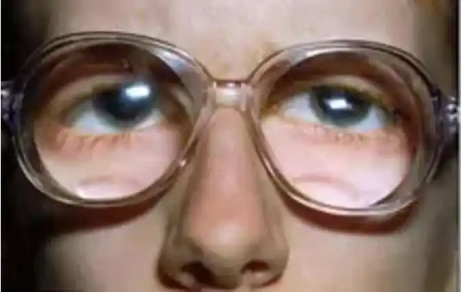 马凡氏综合征:体型造就的"悲情天才"