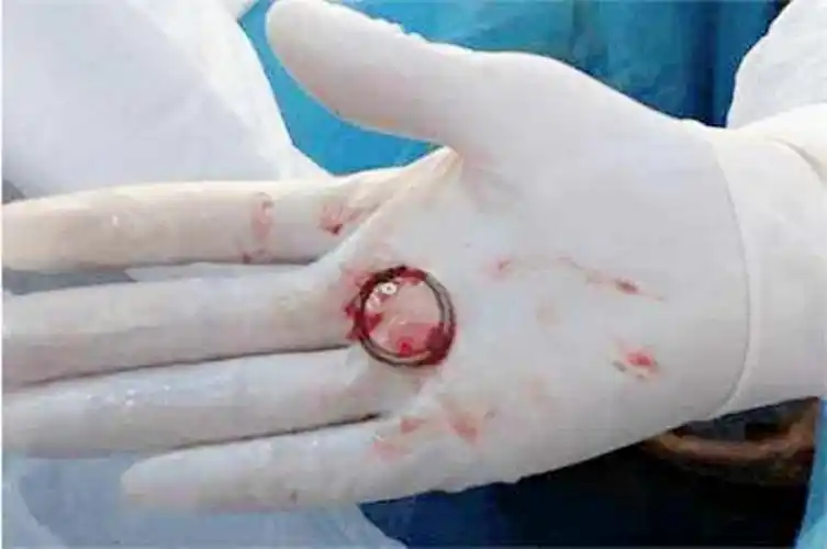 原创30年前选择上环,当年"第一批"女性过得如何?现状让人唏嘘