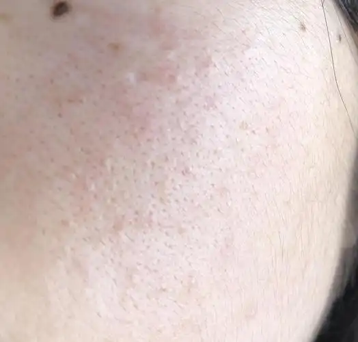 想问一下我脸上这是毛孔粗大!还是什么黑头啊?(.