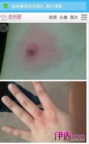 谁能把血毒疮的图片发给我