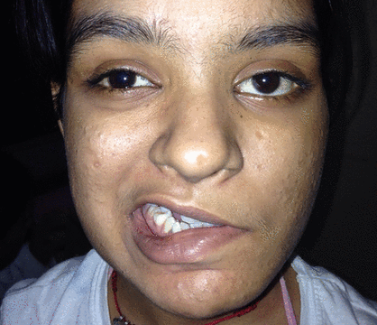 动脉撕裂伤后罕见颅神经麻痹1例