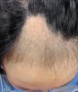 拔毛症会不断拔自己的头发,睫毛,鼻子,眉毛,和身体的其他地区.