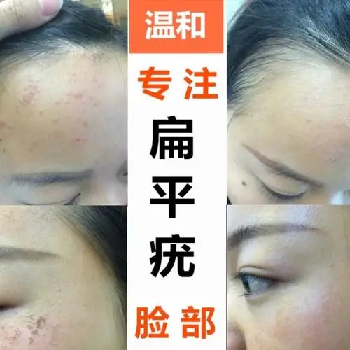治扁平疣药膏面部祛扁平庞点瘊子神器脸部去疣灵疣必治正品一抹灵