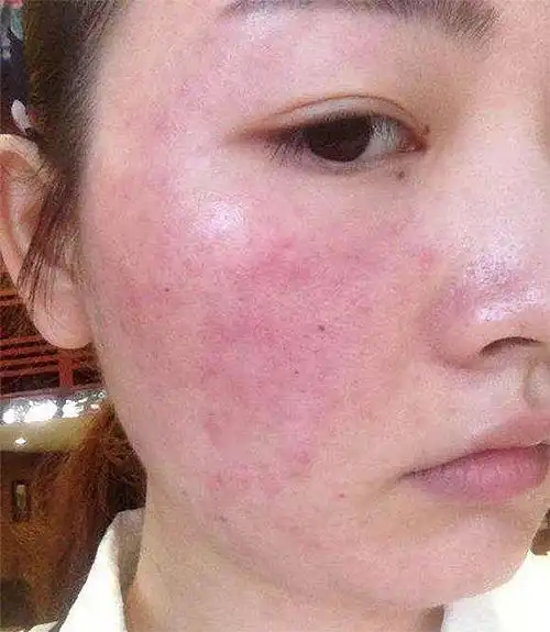 皮肤干燥起皮缺水,别用这4种护肤品,会致.