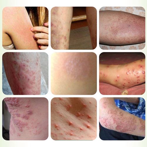 草本去牛皮肤体癣股癣手足屁股大腿根部痒炎皮疹湿止痒外用乳膏真菌