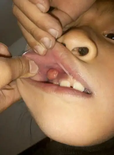 孩子六岁,两侧上部大牙都有虫洞,这两天在右上尖牙牙龈位置长出豌豆