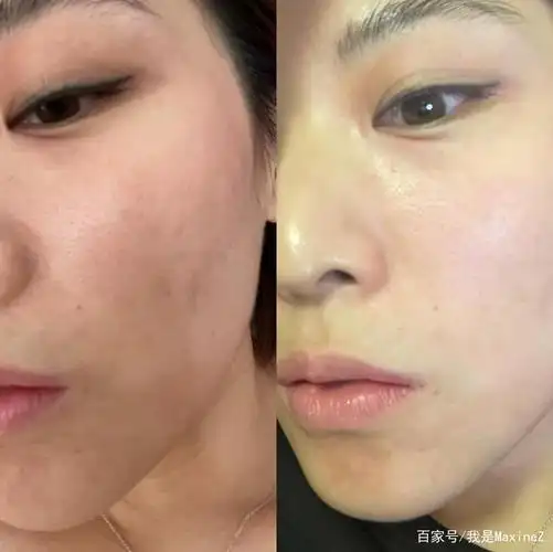 皮肤改善前后对比