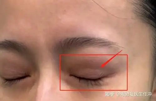 填充眼窝凹陷什么方式最好眶隔脂肪释放才是真香