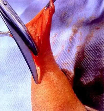 包皮环切手术过程图手术图解