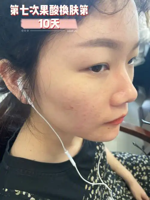 第七次果酸换肤第10天