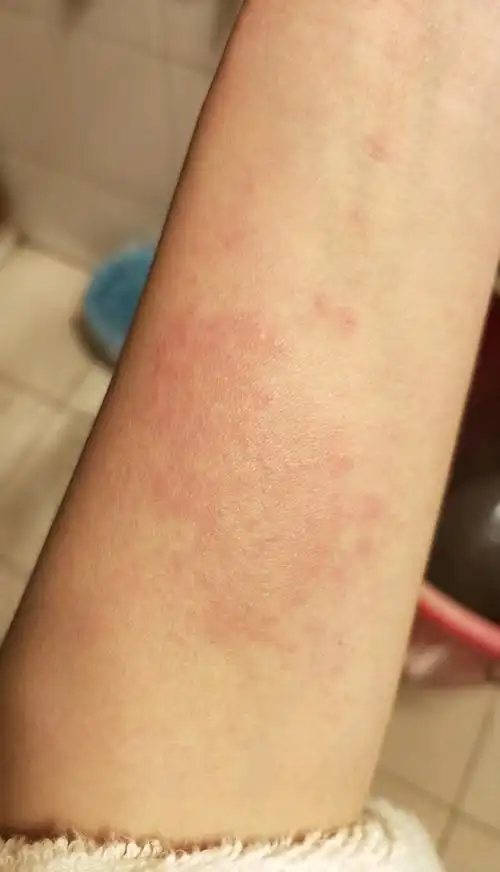 怀孕两个多月,身上痒得难受.