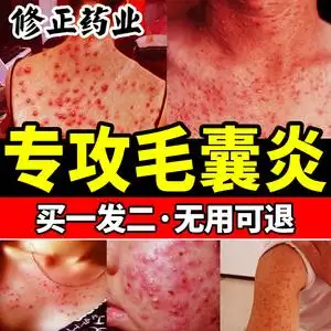 治毛囊炎前胸后背专用手臂胳膊皮肤脸部祛痘痘马拉色菌非特效药膏