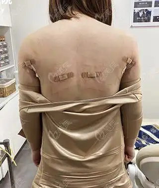 在韩国抽脂好的医院宝士丽整形做完背部吸脂手臂吸脂效果图后才知有多