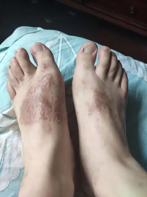 脚湿疹怎么办 脚上的湿疹怎么办