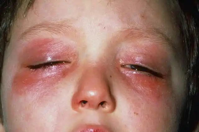 孩子经常揉眼睛请当心:儿子常揉眼睛妈妈不管,结果孩子角膜溃疡