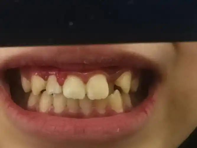 侧切牙错位,这个有必要矫正吗