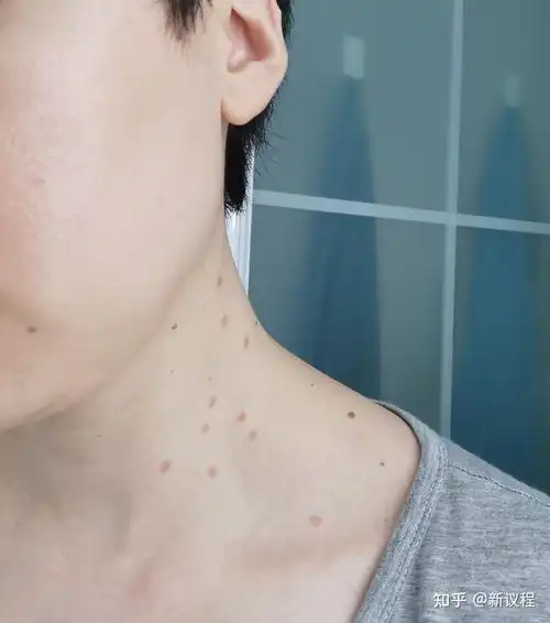 产后脖子丝状疣处理记录