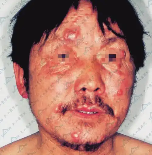 【图】麻风少见的症状表现 - 皮肤病学 - 天山医学院