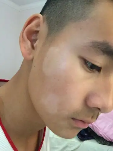 脸上有白斑大概两个月了现在皮肤变的很光滑没有皮屑不痛不