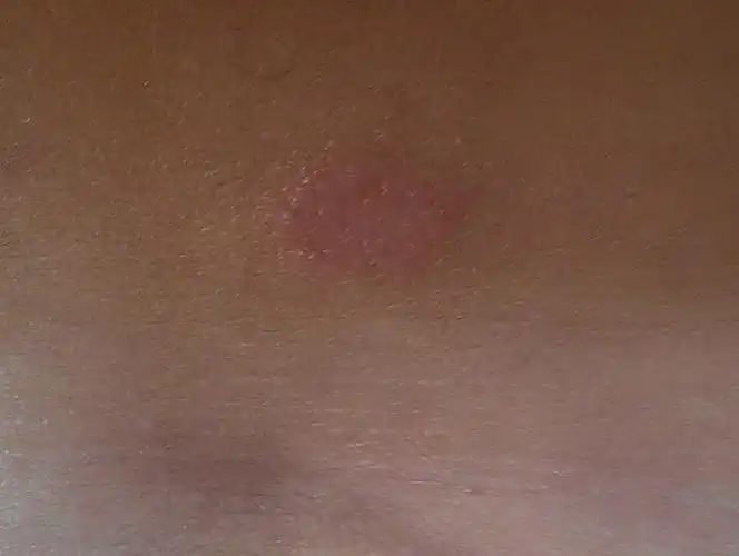 胸前长红点,抓过后有小水泡连在一起,越抓越痒,晚上厉害.