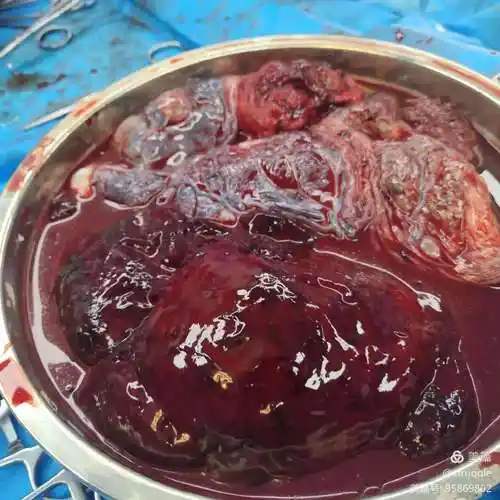 时间就是生命,巫溪妇幼妇产科成功抢救胎盘早剥大出血产妇