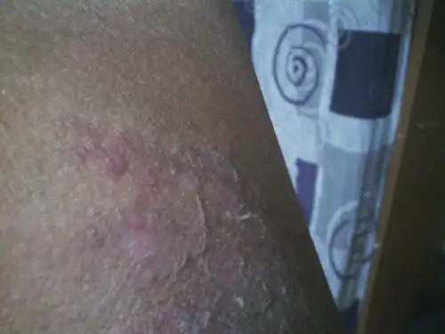 后背体股癣图片_有来医生