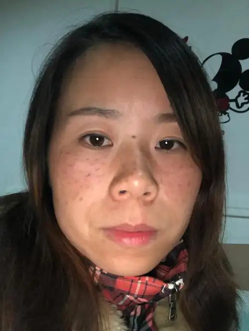 生三孩子后麻子脸加重每天不敢出门见人那种自卑心酸想起就泪流满面