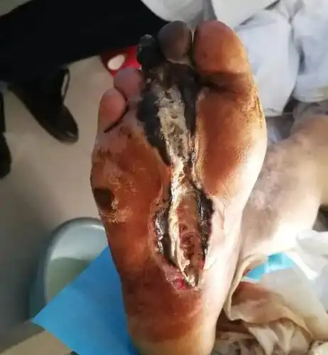 不用截肢也能治严重糖尿病足!