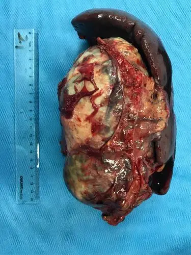 小姑娘,大肿瘤.今天的手术,顺利完成.