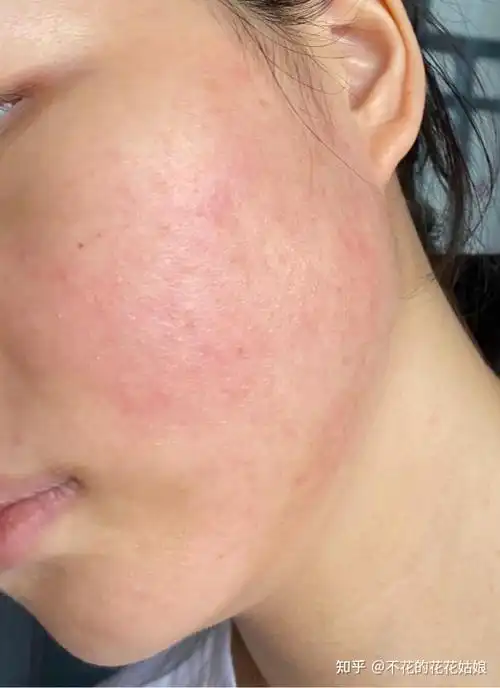 那个陆十六神经酰胺凝露对皮肤泛红真的有用嘛