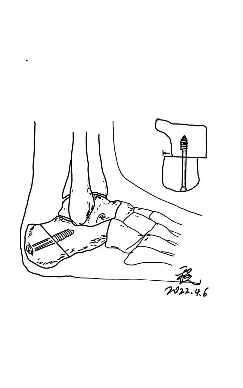 跟骨内移截骨是治疗后足外翻的一种常见术式,多使用跟外侧切口, - 抖
