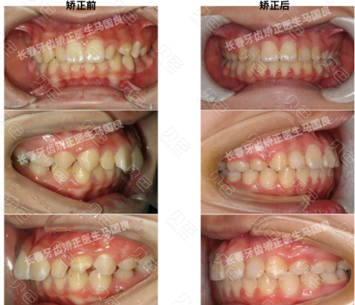 矫正前后对比