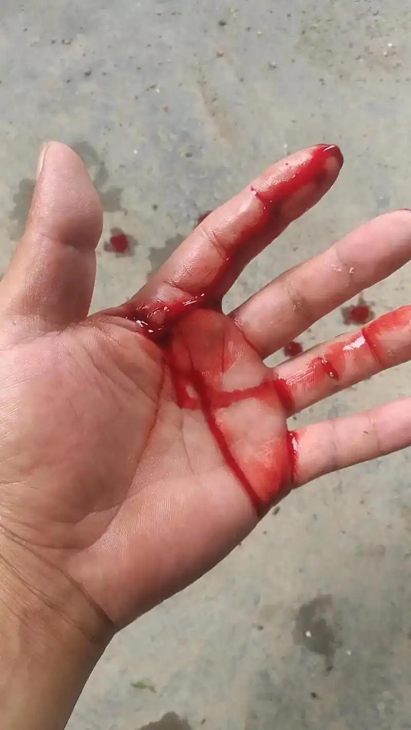 没有人心痛我呀,手伤了,衣服洗不上了,饭也做不上了,活更干不 - 抖音