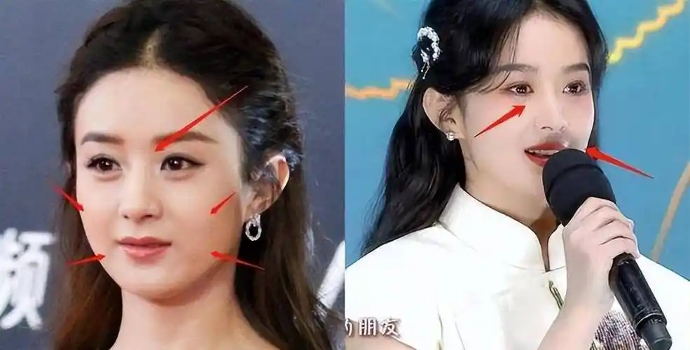 其实赵丽颖的鼻子基础还是相当不错的,本身鼻梁非常挺拔,就是伤口有