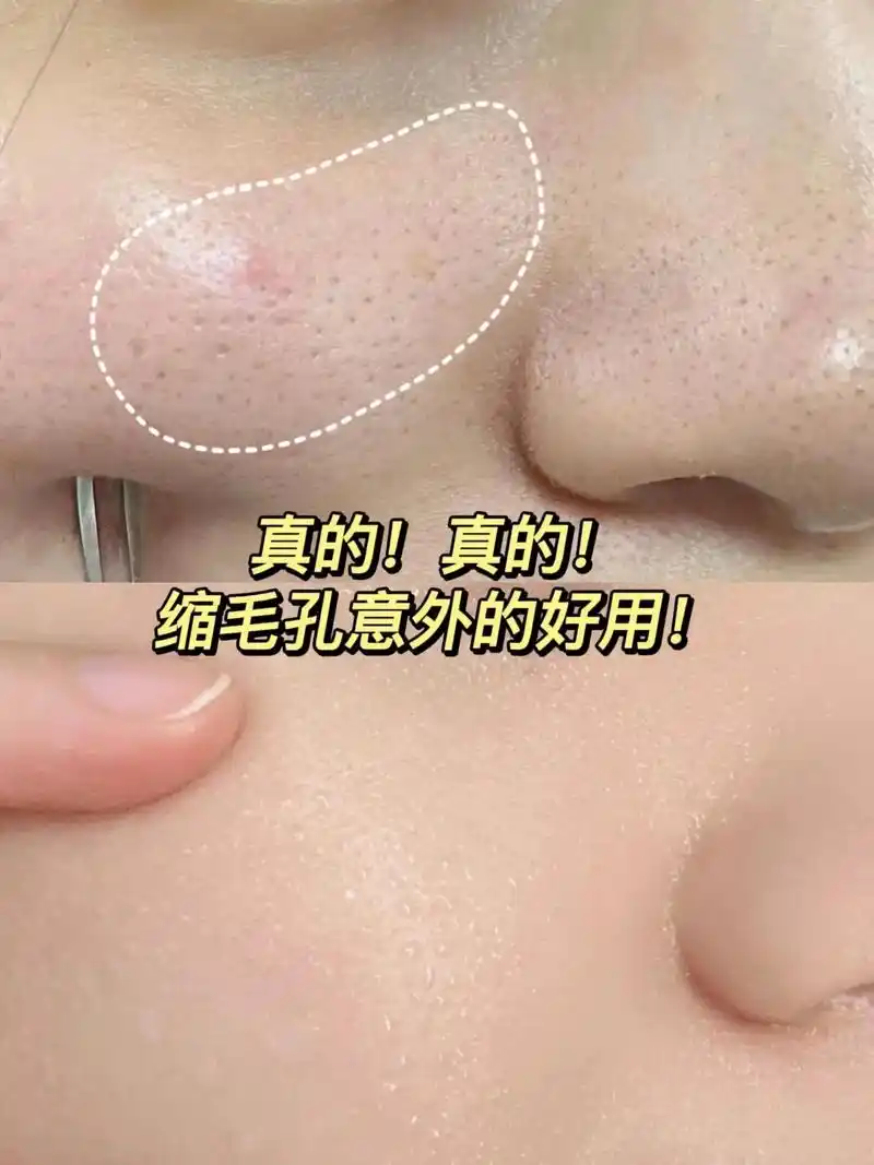 我服了…这满脸的大毛孔终于没了.