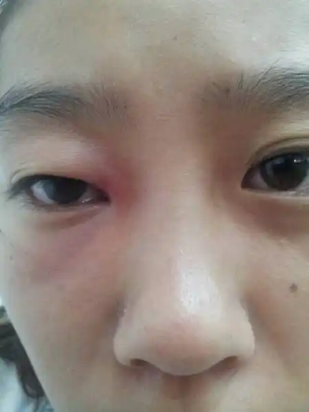 昨天眼角能摸到一颗东西,而且更肿.