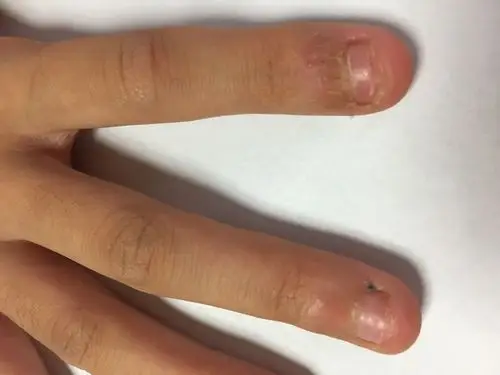 女孩9岁,大班时开始咬手指甲,一直没办法解决,去医院看了,开了三盒贴
