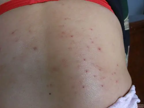 即时求助请大家看看有疥疮的可能性吗