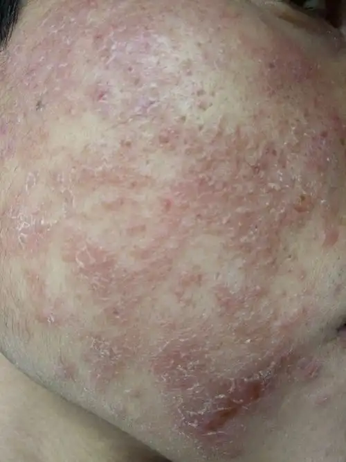 大家帮我看看,本人前段时间脸上皮炎.