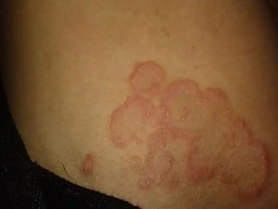 股癣最佳治疗方法(股癣最佳治疗方法大蒜) 股癣最佳治疗方法 第1张