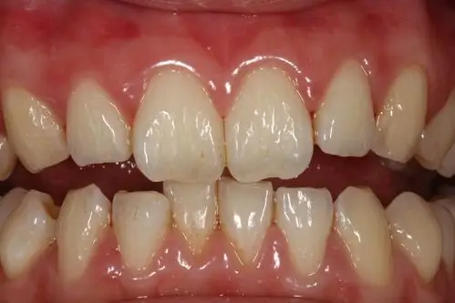 新嫁娘的完美笑容必备一口亮白的牙齿