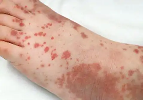 紫癜的早期症状图片