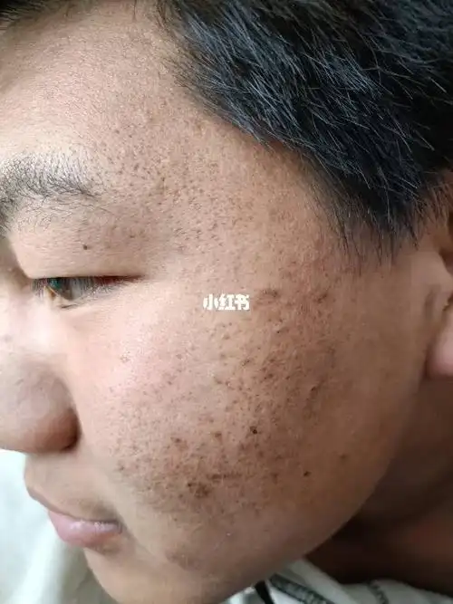 油皮毛孔粗大黑头粉刺