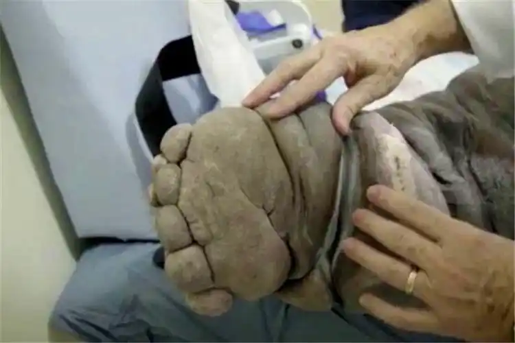 男子左腿变异成大象腿,走路都困难,"真凶"却让人害怕无奈_危害