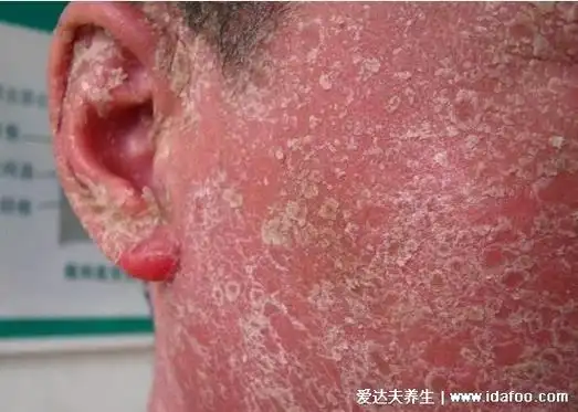 各种常见真菌皮肤病图片及症状对比大全,看图看自己胆小慎点