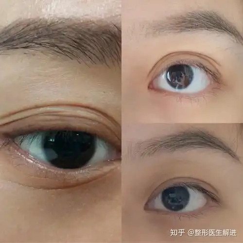 如何改善多层眼皮问题