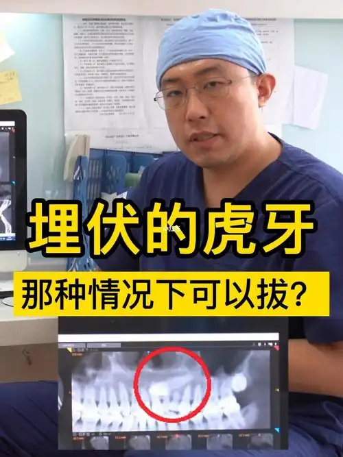 埋伏虎牙案例讲解什么样的埋伏牙需要拔除
